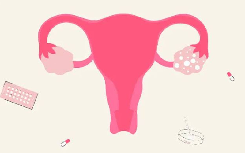 PCOS (Polikistik Over Sendromu) ile Diyabet Arasındaki Bağlantı